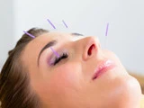 Kosmetisk ansigts akupunktur pakke fra Clinic Chi